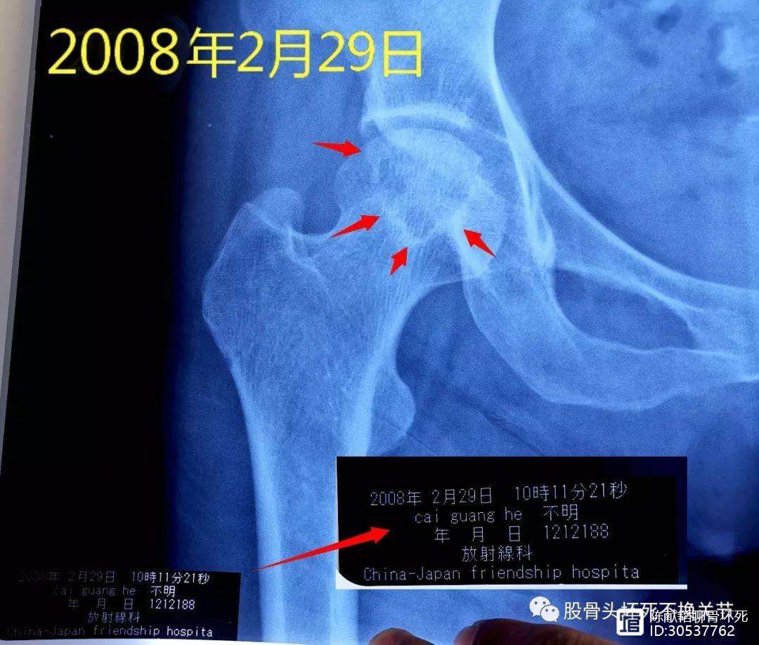 内江人工骨头医保报销多少(人工骨头医保报销多少比例)