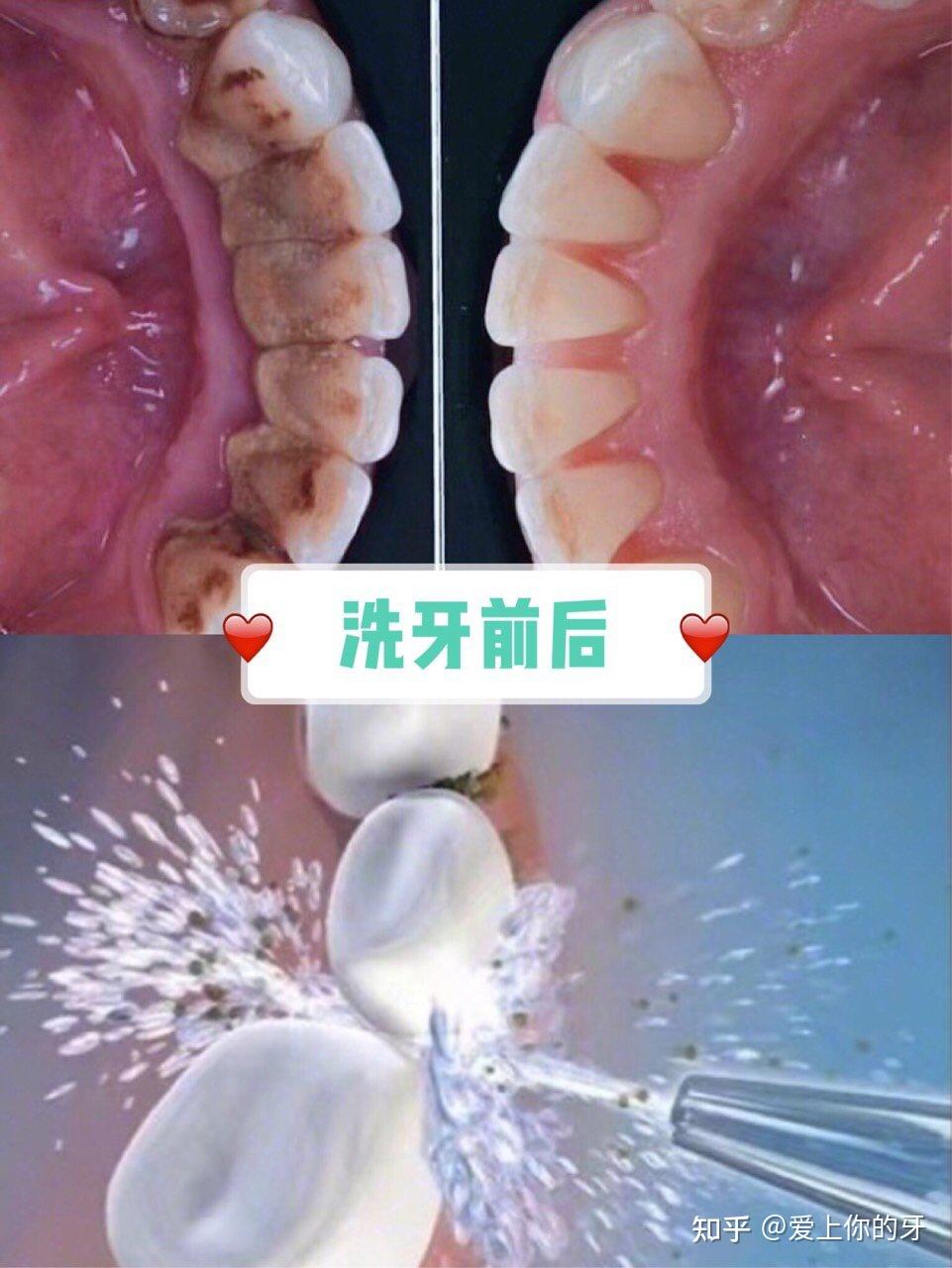 内江洗牙可以用医保吗(洗牙可以用医保吗,报销比例多少)